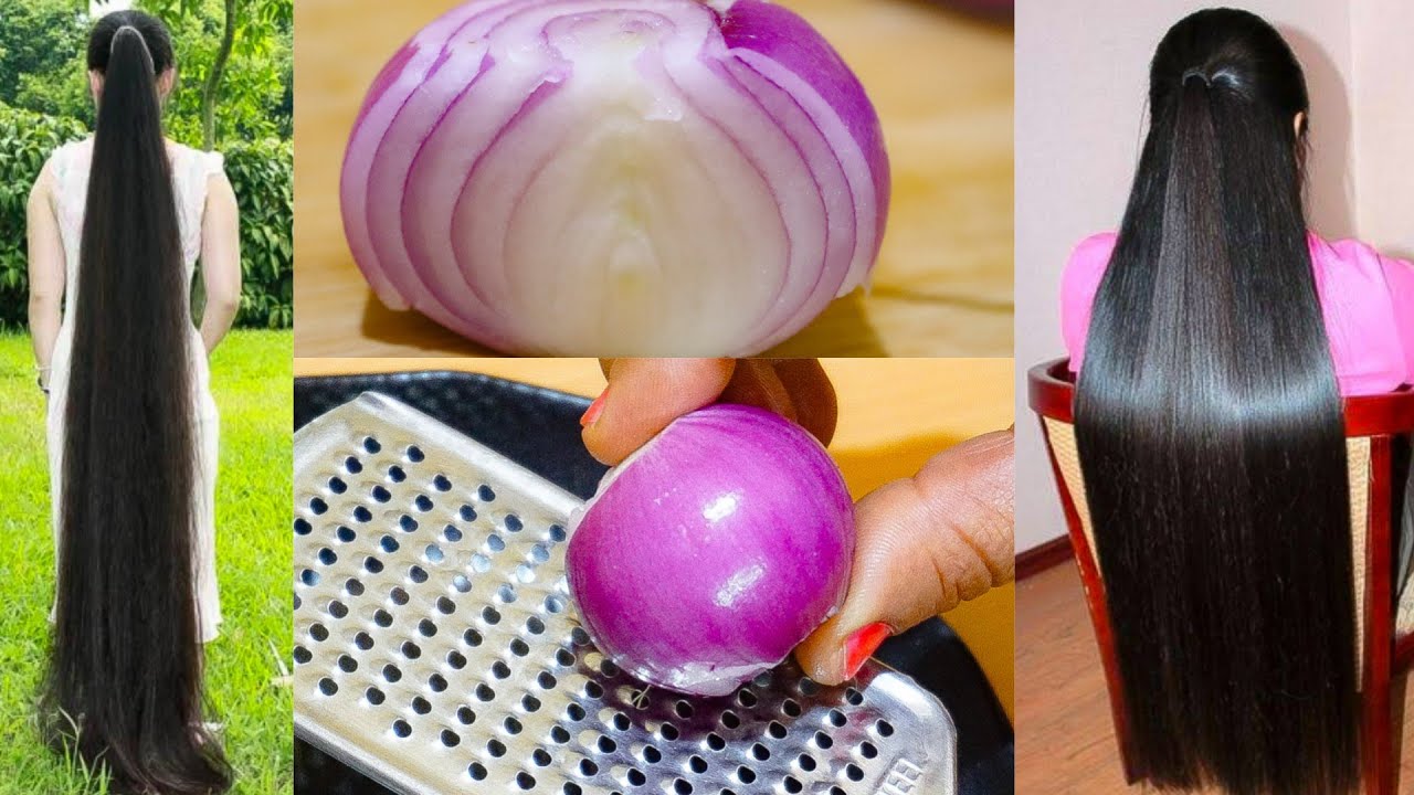 Wie man Zwiebelsaft , Rizinusöl und Ingwer verwendet, um das Haar in wenigen Wochen wachsen zu lassen