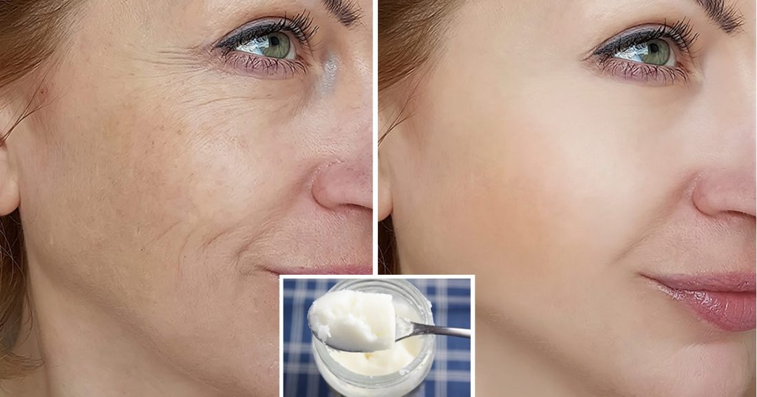 Wie man Kokosöl gegen Falten und Ausdruckslinien verwendet