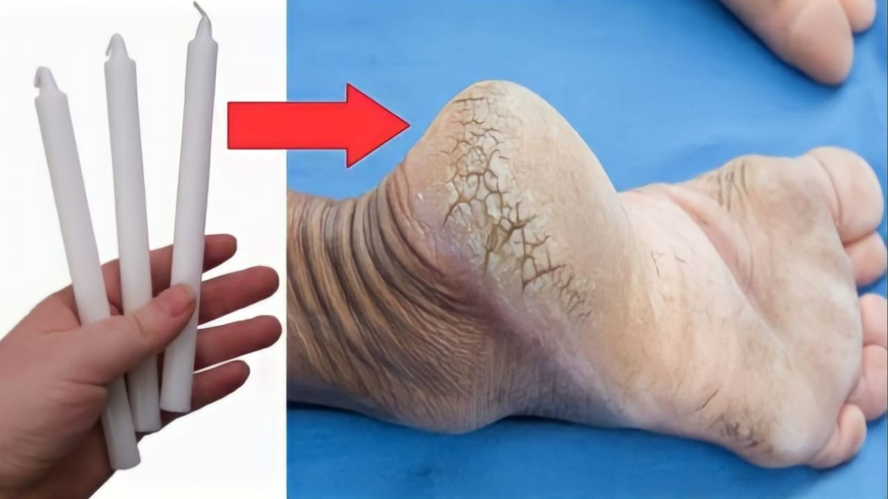 Talons gercés, avec l’astuce de la bougie, vous pouvez vous en débarrasser en 1 jour seulement