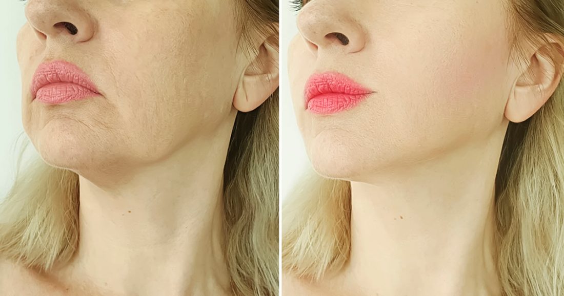 Comment utiliser la vitamine C sur le visage pour obtenir un effet botox