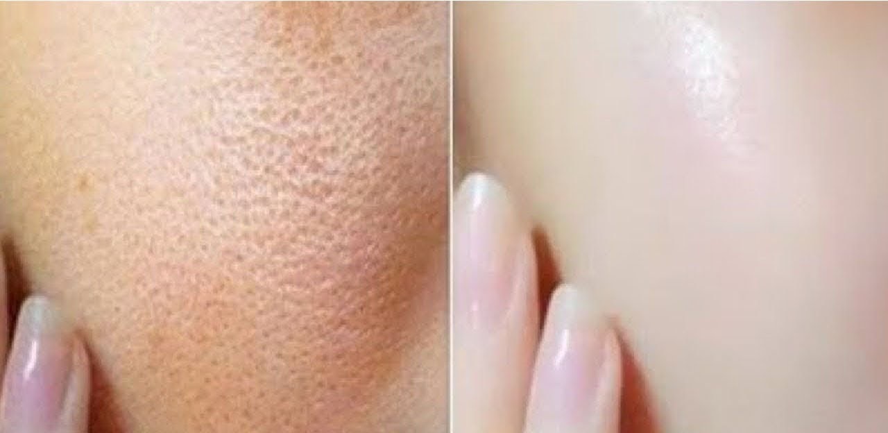 5 Hausmittel, um die Gesichtsporen natürlich zu schließen