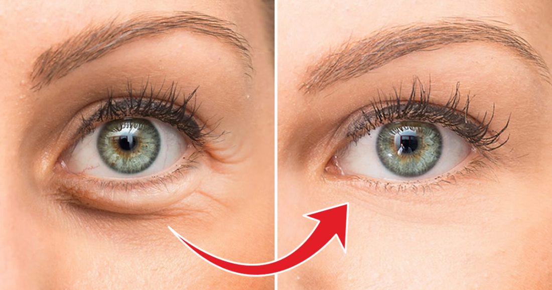 Wie man hängende Augenlider mit 3 DIY-Cremes sofort strafft