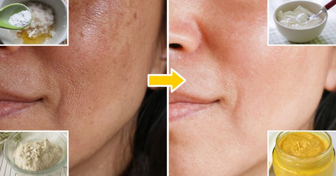 Hautflecken: 4 aufhellende Masken, um sie dauerhaft zu entfernen