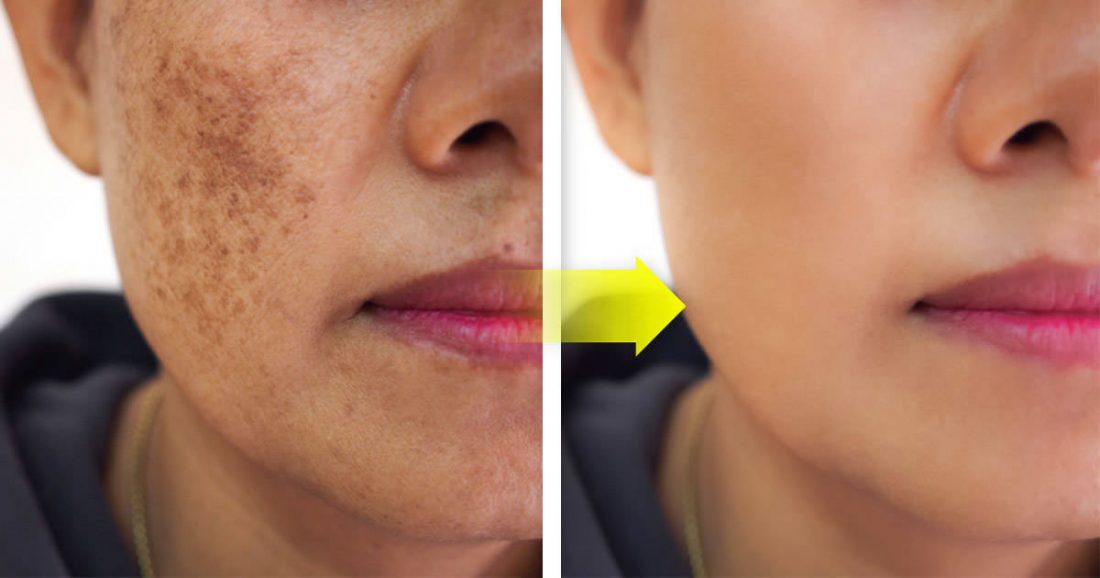 Wie man Petersilie im Gesicht verwendet, um Unreinheiten, Falten und Akne zu beseitigen