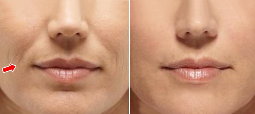 Rides du sourire : 2 crèmes maison pour étirer la peau et les éliminer