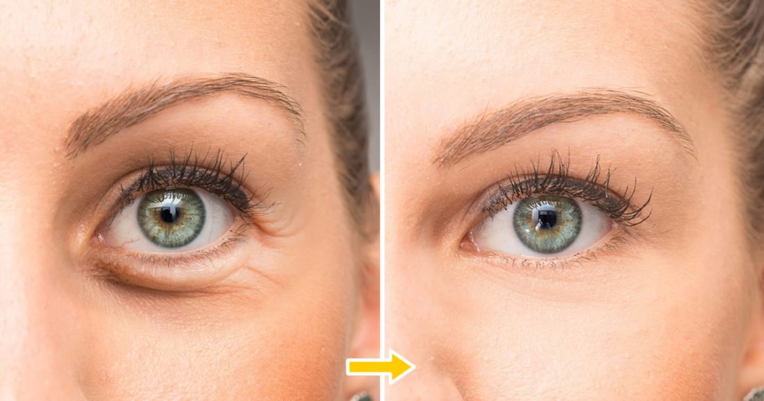 Hängende Augenlider: 3 natürliche Straffungsmittel zum Anheben in 2 Wochen