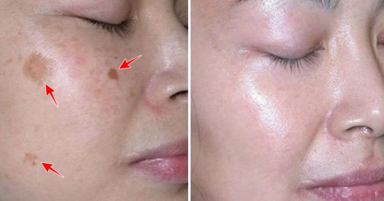 Vitamines pour éliminer les imperfections de la peau